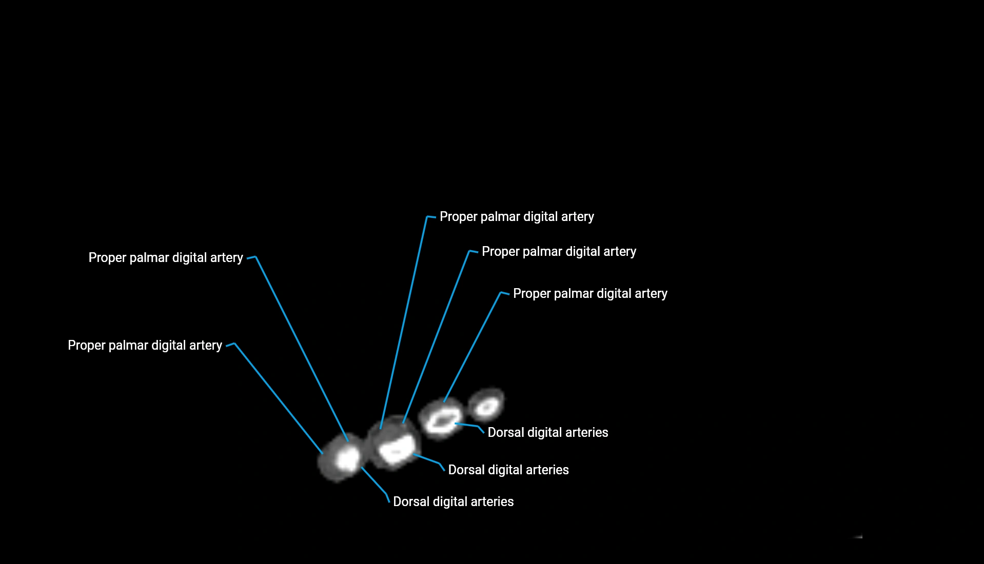 CTA upper limb axial cross sectional anatomy labelled image 25 (3).webp